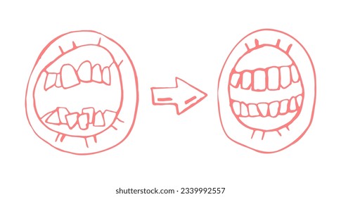 Orthodontic treatment result. Invisible braces aligner, retainer. Medical scheme. Stomotology, orthodontics therapy concept. Landscape poster. Editable vector illustration isolated on white background