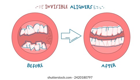 Orthodontic treatment result. Invisible braces aligner, retainer. Medical scheme. Stomotology, orthodontics therapy concept. Landscape poster. Editable vector illustration isolated on white background