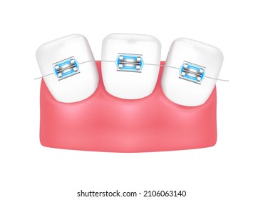 Estilo de tratamiento ortodoncista moda azul hermoso. Dientes blancos con corchetes metálicos. Las llaves dentales están aisladas en un fondo blanco. Vector 3D realista. Concepto de salud de la atención dental.