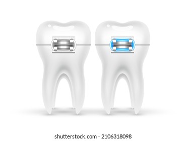 Orthodontic treatment style fashion beautiful blue. White teeth with metal brackets. Tooth braces isolated on a white background. Realistic 3D vector. Dental care health concept.