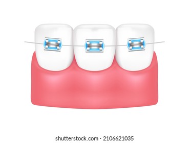 Estilo de tratamiento ortodoncista moda azul hermoso. Dientes blancos con corchetes metálicos. Las llaves dentales están aisladas en un fondo blanco. Vector 3D realista. Concepto de salud de la atención dental.