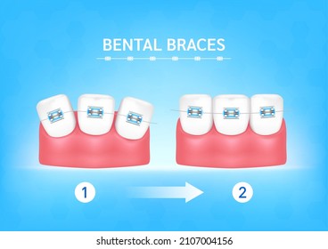 Orthodontic treatment style fashion beautiful blue. White teeth with metal brackets. Tooth braces isolated on a blue background. Realistic 3D vector. Dental care health concept.