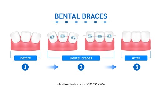 Orthodontic treatment style fashion beautiful blue before and after. White teeth with metal brackets. Tooth braces isolated on a white background. Realistic 3D vector. Dental care health concept.