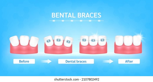 Orthodontic treatment style fashion beautiful blue before and after. White teeth with metal brackets. Tooth braces isolated on a blue background. Realistic 3D vector. Dental care health concept.