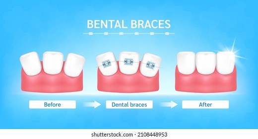 Orthodontic treatment style fashion beautiful blue before and after. White teeth with metal brackets. Tooth braces isolated on a blue background. Realistic 3D vector. Dental care health concept.