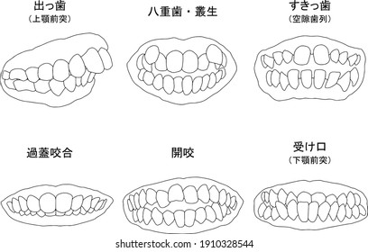 Orthodontic Treatment Symptom Line Artmeaning Protruding Stock Vector ...