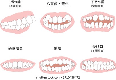 Orthodontic treatment Symptoms Line art Colored.meaning is "protruding teeth(Maxillary　prognath)","cuspid","sukippa(Void dentition)","Overcapsular occlusion","Open bite","Protruding chin"