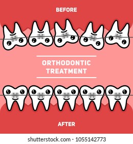 Orthodontic treatment, teeth braces, vector illustration before and after.