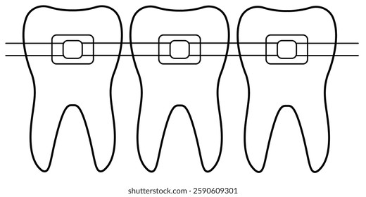 Ilustração Ortodôntica de Vetor Mostrando Chaves nos Dentes com Colchetes Dentários. Ilustração apresentando um diagrama detalhado de dentes com chaves e suportes ortodônticos simbolizando alinhamento dentário. 