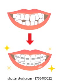 Orthodontics before and after illustrations