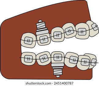 Orthodontics and dental implants dental treatment oral care - flat illustration 