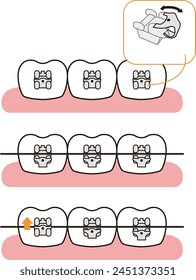 
Orthodontics how to use braces of Damon System - flat illustration 