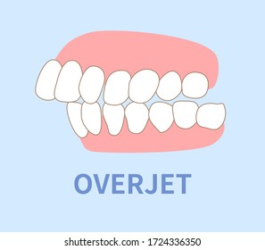  orthodontics  illustrations ; crowding, opposite occlusion, open bite, maxillary anterior protrusion, cavities, dentition, overjet