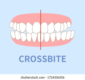  orthodontics  illustrations ; crowding, opposite occlusion, open bite, maxillary anterior protrusion, cavities, dentition, crossbite