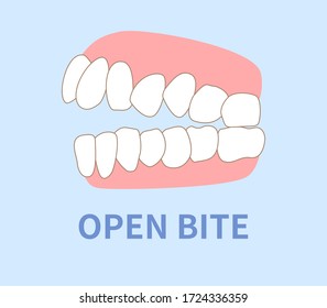  orthodontics  illustrations ; crowding, opposite occlusion, open bite, maxillary anterior protrusion, cavities, dentition