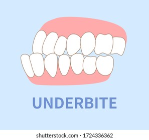  orthodontics  illustrations ; crowding, opposite occlusion, open bite, maxillary anterior protrusion, cavities, dentition, underbite