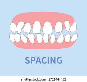 orthodontics  illustrations ; spacing tooth