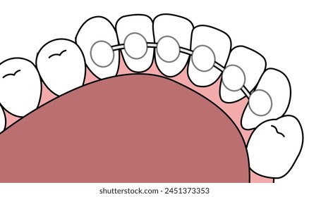 
Orthodontics lingual Brace 
orthodontic maintainer - flat illustration 