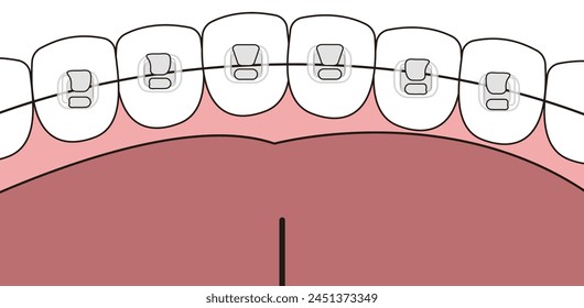 
Orthodontics lingual Braces and mouth  - flat illustration 