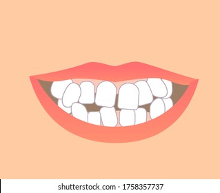 Orthodontics teeth before and after