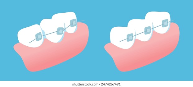Orthodontics, teeth and gums vector illustration on blue background