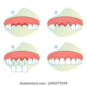 Orthodontics and Tooth Implant - Bridge Missing Tooth  - Dental Care Stock Icon  as EPS 10 File