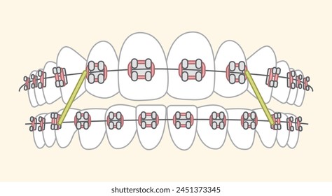 
Orthodontics traditional braces  - flat illustration 