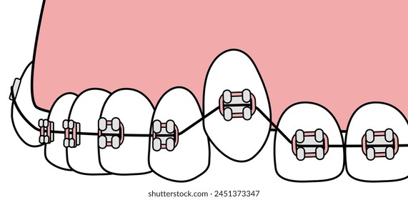 
Orthodontics traditional braces  - flat illustration 