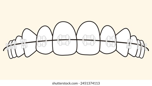 
Orthodontics traditional Clarity braces  - flat illustration 