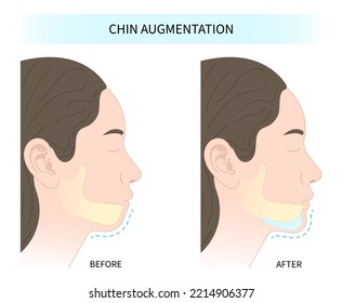 Orthodontist Temporomandibular and joint Orthodontic double long Dermal chin augmentation facial nose reshaping contour rhytidectomy grafting