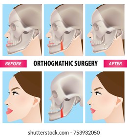 Orthognathic surgery vector illustration