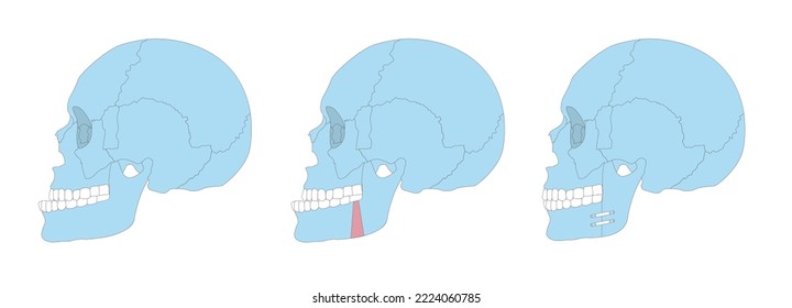 Orthognathic surgery vector illustration overbite teeth dental