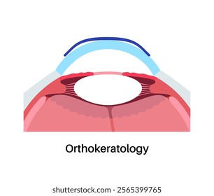 Orthokeratology fitted contact lens. Reshape the cornea to improve vision. Ortho k correct nearsightedness or myopia. Cornea and retina anatomy, human eye disease treatment flat vector illustration.