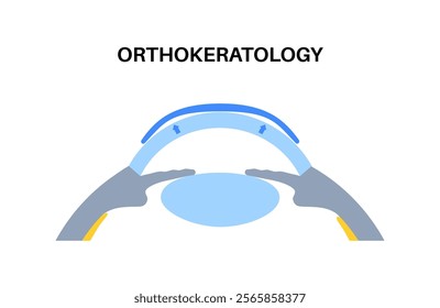 Orthokeratology fitted contact lens. Reshape the cornea to improve vision. Ortho k correct nearsightedness or myopia. Cornea and retina anatomy, human eye disease treatment flat vector illustration.