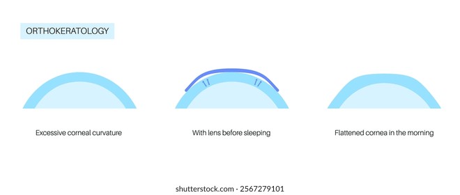 Orthokeratology fitted contact lens. Reshape the cornea to improve vision. Ortho k correct nearsightedness or myopia. Cornea and retina anatomy, human eye disease treatment flat vector illustration.