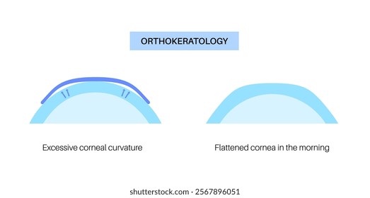 Orthokeratology fitted contact lens. Reshape the cornea to improve vision. Ortho k correct nearsightedness or myopia. Cornea and retina anatomy, human eye disease treatment flat vector illustration.