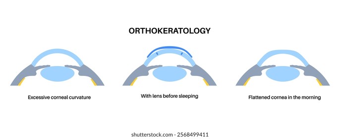 Orthokeratology fitted contact lens. Reshape the cornea to improve vision. Ortho k correct nearsightedness or myopia. Cornea and retina anatomy, human eye disease treatment flat vector illustration.