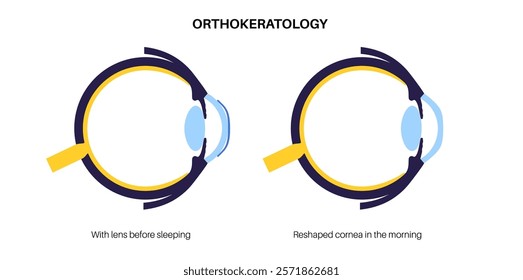 Orthokeratology fitted contact lens. Reshape the cornea to improve vision. Ortho k correct nearsightedness or myopia. Cornea and retina anatomy, human eye disease treatment flat vector illustration.