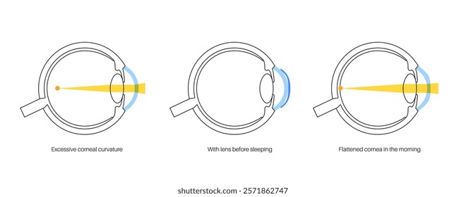 Orthokeratology fitted contact lens. Reshape the cornea to improve vision. Ortho k correct nearsightedness or myopia. Cornea and retina anatomy, human eye disease treatment flat vector illustration.