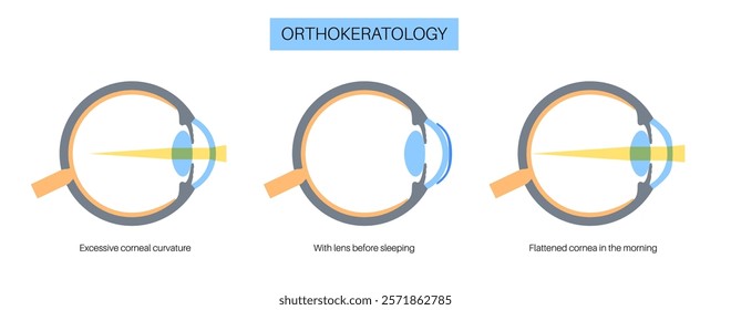 Orthokeratology fitted contact lens. Reshape the cornea to improve vision. Ortho k correct nearsightedness or myopia. Cornea and retina anatomy, human eye disease treatment flat vector illustration.