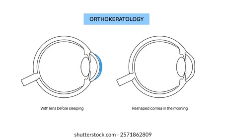 Orthokeratology fitted contact lens. Reshape the cornea to improve vision. Ortho k correct nearsightedness or myopia. Cornea and retina anatomy, human eye disease treatment flat vector illustration.