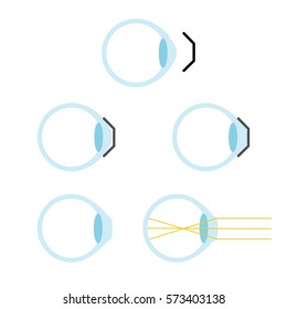 Orthokeratology mechanism. Stock vector illustration for night lenses that reshape eye cornea form and improve vision.