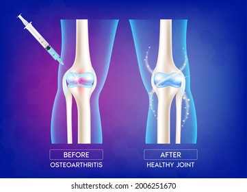 Orthopedic injection with syringe needle to damaged joint and healthy because of treatment knee anatomical. Osteoporosis treatment before and after. Medical skeleton x ray scan concept. 3D Vector
