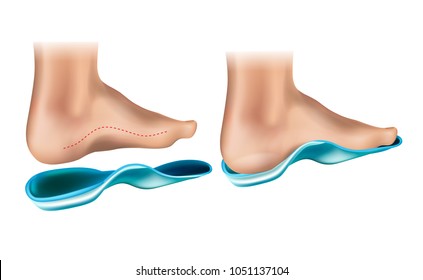 Orthopädische Sohle.  Orthotische Artenunterstützung