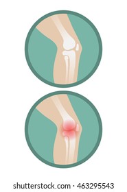 Orthopedic medical vector icons. Disease of the joints and bones, arthritis.
