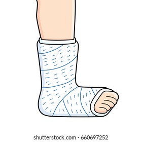 Orthopedic plaster or fiberglass cast, broken leg, bone fracture, vector isolated.