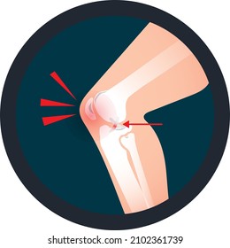 Icono de rodilla ortopedia una lesión de ACL o (Ligamento Cruzado anterior).