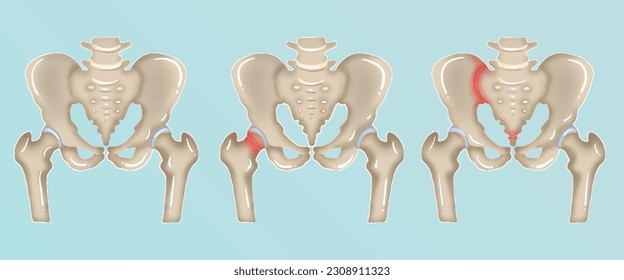 Orthopedics of pelvis and hip fracture anatomy in watercolor style.