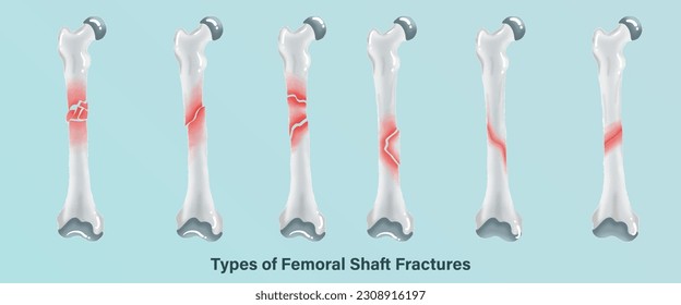 Orthopedics of Types of Femoral Shaft Fractures Anatomy in watercolor style.