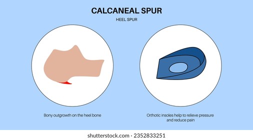 Orthotic insoles concept. Discomfort when walking or running. Plantar fasciitis or heel spur treatment. Feet pain, injury, swelling, painful inflammation of the foot isolated flat vector illustration